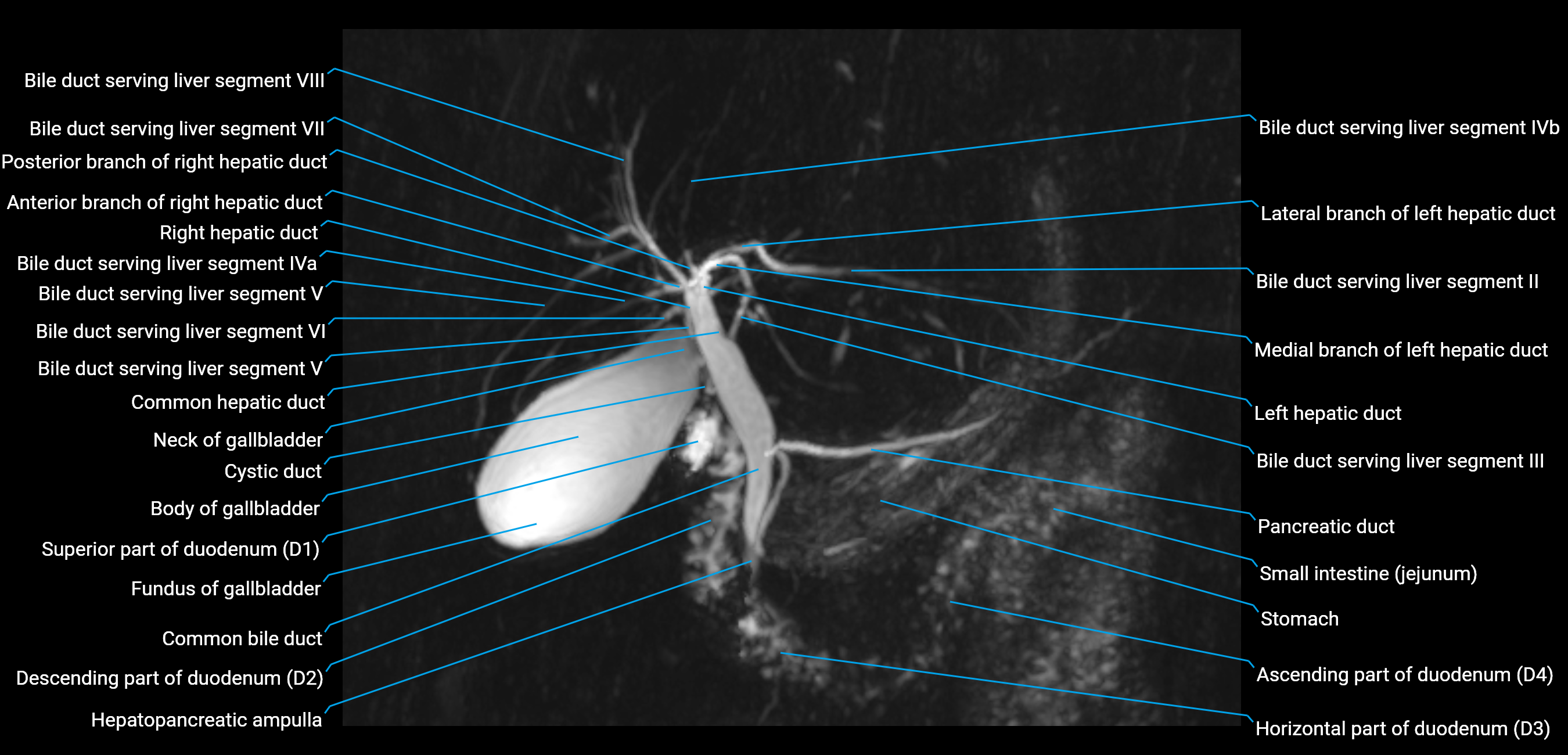 MRCP MIP MRI  anatomy labelled image-img-01003-00010.png